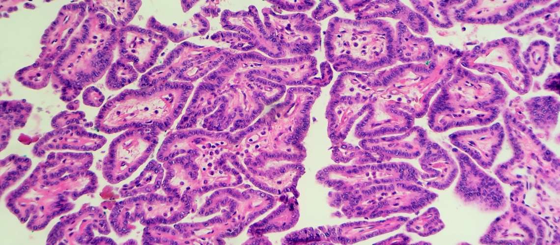 Papiller Tiroid Kanseri