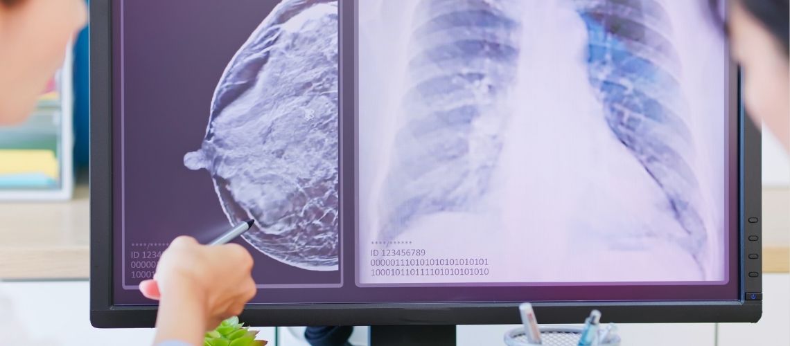 Ileri Evre Evre 4 Meme Kanseri Nedir Nasil Tedavi Edilir İleri Evre (Evre 4) Meme Kanseri Nedir? Nasıl Tedavi Edilir?