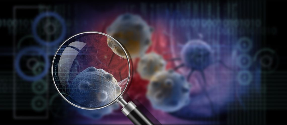 Metastaz Yapan Meme Kanseri Iyilesir Mi Metastaz Yapan Meme Kanseri İyileşir Mi?