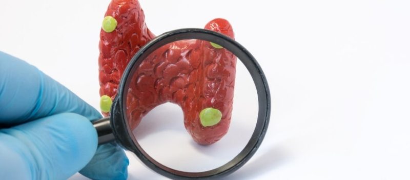 Paratiroid Adenom Nedir Tedavisi Nasil Yapilir Paratiroid Adenomasının Müalicəsi