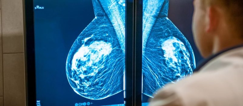 Meme MR Kontrast Tutulumu Meme MR Kontrast Tutulumu